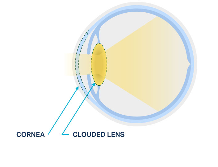Diagram of a normal lens versus a cloudy lens from a cataract